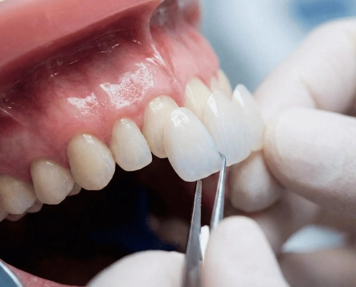 Porcelain Veneers — Premium Aesthetics