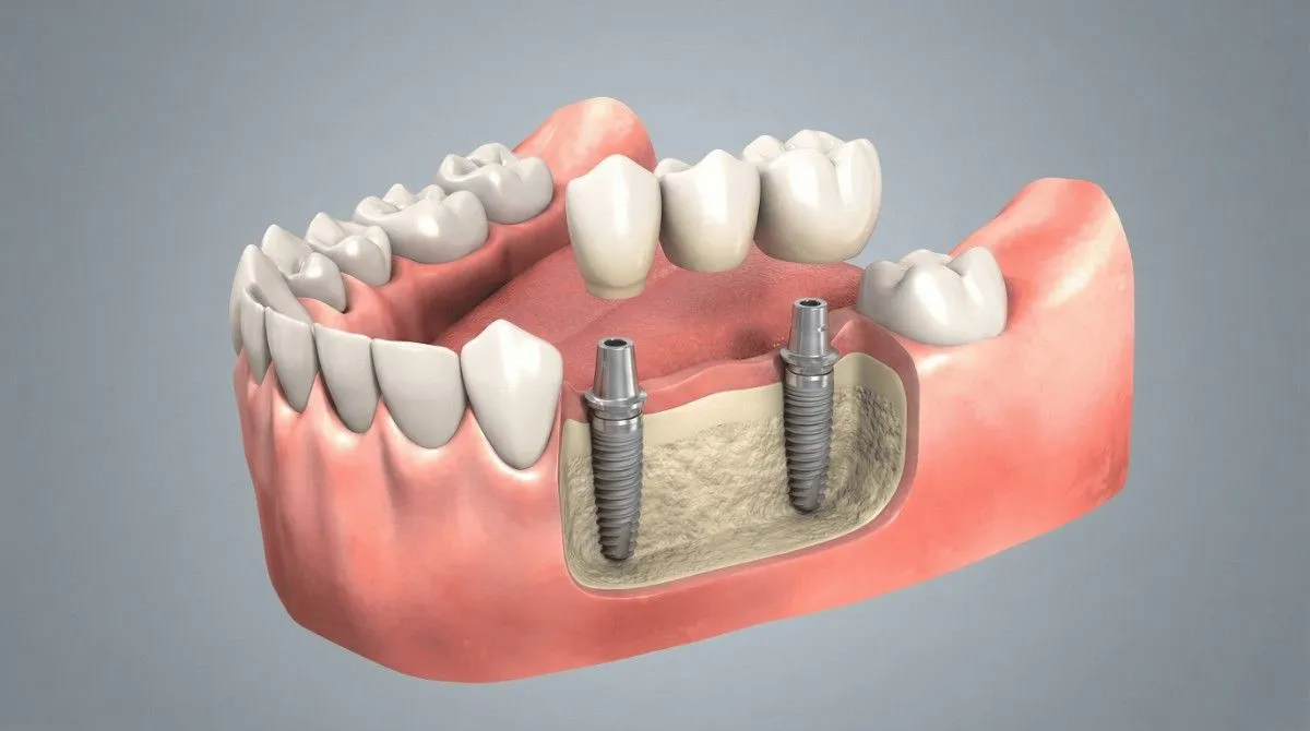 Dental Implants — Natural Feel, Lasting Support
