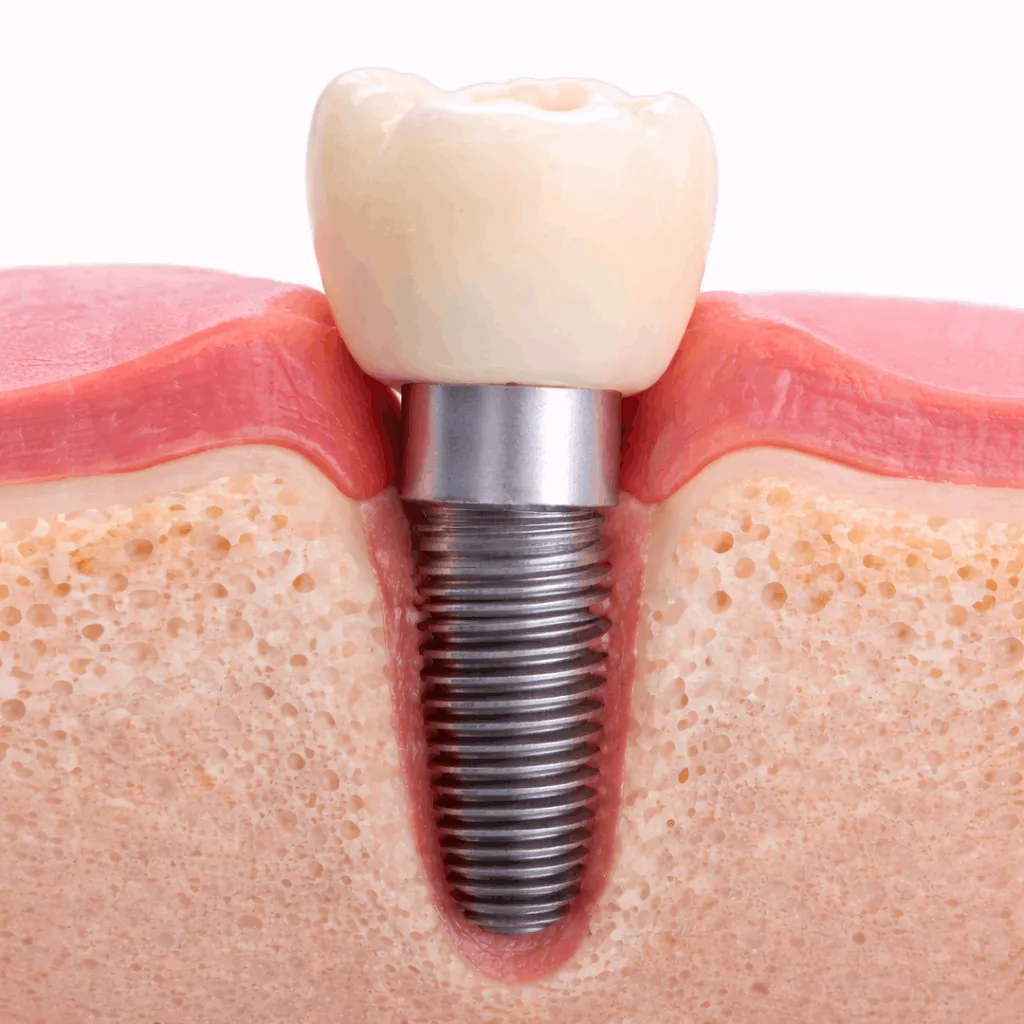 How Dental Implants Work